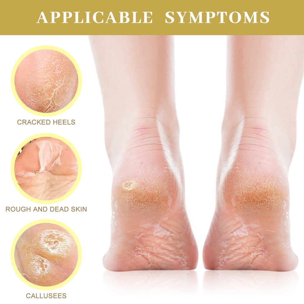 Berlaney Moisturizing Foot Mask with Shea Butter, Moisturizing Foot Mask for Dry and Cracked Feet, Dry Skin Moisturizer for Soft and Smooth Feet