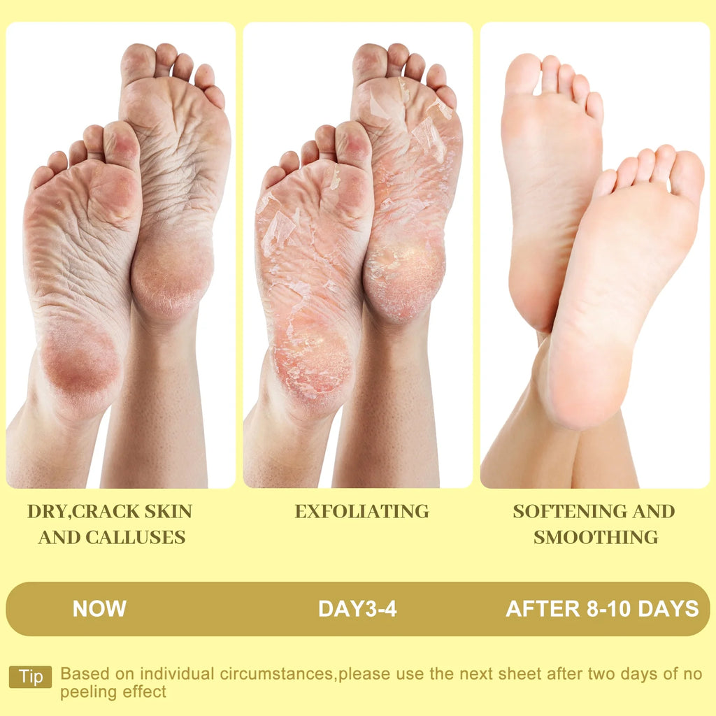 Berlaney Moisturizing Foot Mask with Shea Butter, Moisturizing Foot Mask for Dry and Cracked Feet, Dry Skin Moisturizer for Soft and Smooth Feet